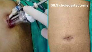 SINGLE INCISION (SILS) LAPAROSCOPIC CHOLECYSTECTOMY