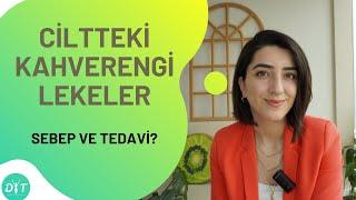 CİLTTEKİ KAHVERENGİ LEKELER | HİPERMELANOZİS | YAĞMUR YAŞAR UĞUR