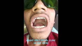 Oral Submucous Fibrosis Treatment Done By Laser Increase Mouth Opening In 20Minutes.