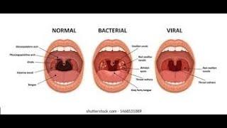 Pharyngitis, Part 1; Viral Pharyngitis