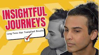 Hair Transplant in India | A hair transplant result 7 years after