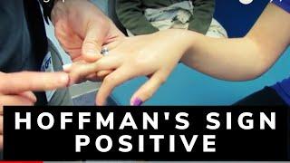 Hoffman's Sign - Positive