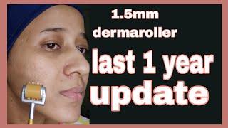 1.5mm dermaroller|1year skin update|derma roller for acne scars