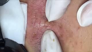 Satisfying Relaxing with Vien Tham My DrAZI #vienthammydrazi0163 #acne #pimples #blackheads