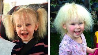 Девочка 9 лет не расчесывалась. Синдром нерасчёсываемых волос.