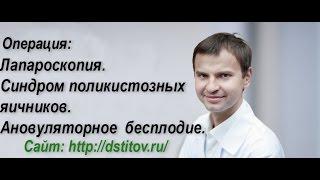 Лапароскопия. Синдром поликистозных яичников. Ановуляторное  бесплодие.