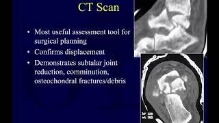 Talus fractures 1 - assessment  (OTA lecture series III l14a)