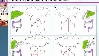 Colorectal liver metastases multidisciplinary approach 2  Prof  Mohamed Fathy Abdel Ghaffar