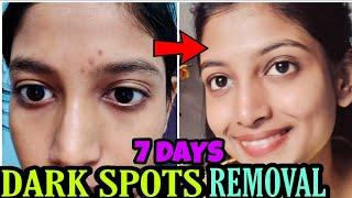 Real Experience  Dark Spots Treatment Naturally at home