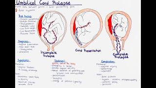 umbilical cord prolapse + cord presentation -  Types, Risk Factors, Diagnosis,  Treatment etc