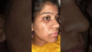 Tretinoin cream 0.025% transformation No acne No dark spot #acne #skincare #tretinoin #darkspots