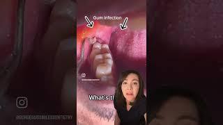 Gum infection / inflammation or is it Pericoronitis?