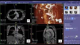 Thoracic Endovascular Aortic Repair (TEVAR)