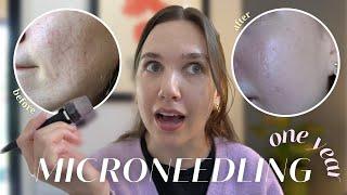 What ONE YEAR of Microneedling Did To My Skin... | Acne Scarring Before & After | Banisher 2.0