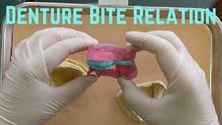 Bite Registration for a denture