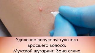 Удаление папулопустульного вросшего волоса. Мужской шугаринг. Зона спина.