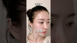 M자 탈모 극복, 얼굴 확 작아진 모발이식 결과 공개!