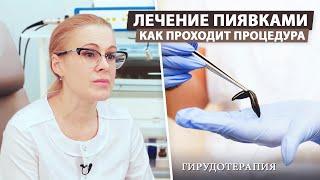 Как проходит процедура лечения пиявками (Гирудотерапия)