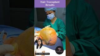 Amazing hair transplant result at Dr. Rashmi Aderao Skin, Hair & Laser Clinic