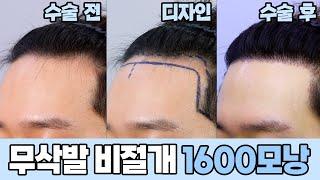 남성모발이식 전후영상무삭발비절개 1600모낭｜모발이식｜헤어라인교정｜두피문신｜다나성형외과DANA