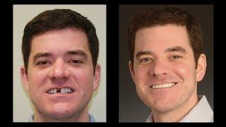 SMILE Technique Same Day Dental Implants with Top Charlotte Dentist