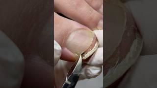 Система препаратного педикюра 10|11 #nails #podologia #ногти #pedicure #педикюр #подолог
