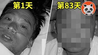 核輻射死亡83天全紀錄，看著自己融化是種什麼體驗？他遭受2萬倍的輻射量，世界上死的最慘的人【熊貓周周】