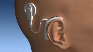 Beyond a Hearing Aid - Mayo Clinic