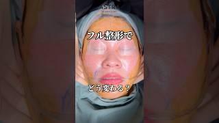 フル整形でどう変わる？#astrabeautyclinic  #アストラビューティークリニック #塩満恵子 #鼻整形 #美容整形 #忘れ鼻