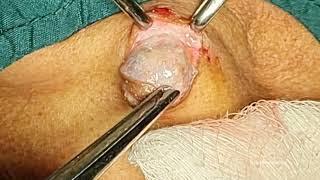 Excision of Sebaceous Cysts in all Their Shapes and Forms - for Medical Students