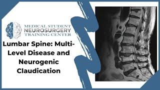 Lumbar Spine: Multi-Level Disease and Neurogenic Claudication