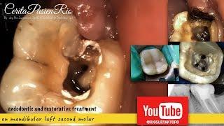 root canal treatment on mandibular molar - perawatan gigi berlubang saluran akar dokter gigi