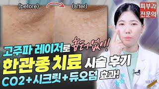 획기적인 최신 레이저로 흉터 없이! 한관종 치료 QnAㅣ노남경의 피부클래스