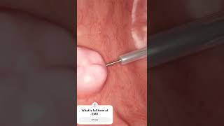 EMR, endoscopic mucosal resection for colonic polyp