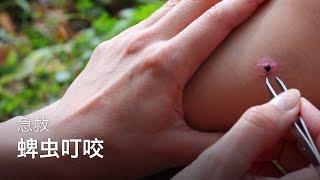 急救：蜱虫叮咬 | 学习急救