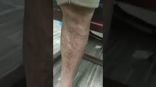 c2 varicose veins