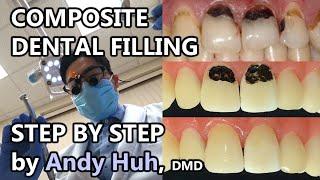 Composite Dental Filling Procedure Steps, Tooth-colored, White  레진 충치 치료 Andy Huh @ Evergreen Dental