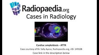 Cardiac amyloidosis (Radiopaedia.org) Cases in Radiology