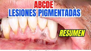 ABCDE de Lesiones Pigmentadas (Resumen)