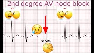 ECG arrhythmias explained