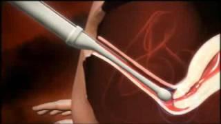 3D animation of how IVF works