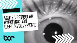 Acute Vestibular Hypofunction Spontaneous Nystagmus (Left)