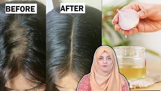 2x Faster Hair Growth & Stop Hair Fall    ll Magical Onion Hair Oil For  Thick, Long, Healthy Hair