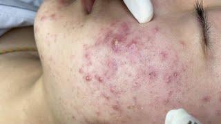 Puberty Acne | Mụn Trứng Ca, Mụn Viêm Tuổi Dậy Thì - SacDepSpa#302