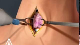 Tracheotomy - 3D animation