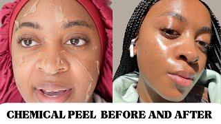 CHEMICAL PEEL FULL PROCESS BEFORE & AFTER | HYPERPIGMENTATION/ACNE ON BLACK SKIN | THE PERFECT PEEL