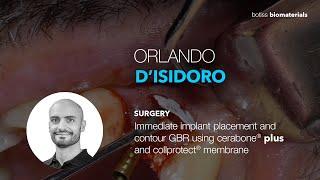 SURGERY: Immediate implant placement and contour GBR using cerabone® plus and collprotect® membrane