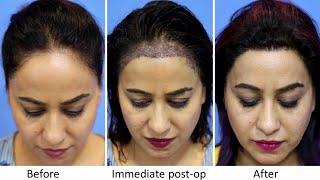 Female Hair Transplant Clinic in Mumbai, | Before and After Result | @EugenixHairSciencesofficial