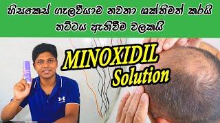 Treatment For Hair Loss | Minoxidil | Sinhala Medical Channel