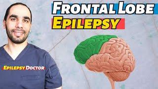 Frontal Lobe Epilepsy, Diganosis and Treatment